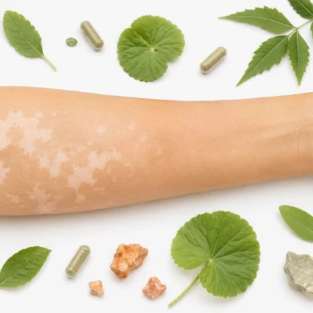 Vitilinox natural supplement ingredients supporting vitiligo repigmentation and skin pigment recovery